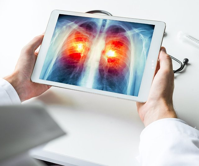 Spanish research on lung cancer increases survival by 20% and will benefit 6,000 patients a year