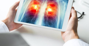 Spanish research on lung cancer increases survival by 20% and will benefit 6,000 patients a year